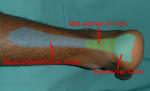 Tendinopathy