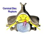 cervical disc