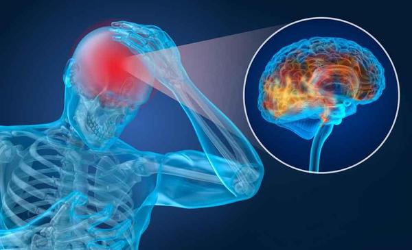 What is a Migraine Headache?