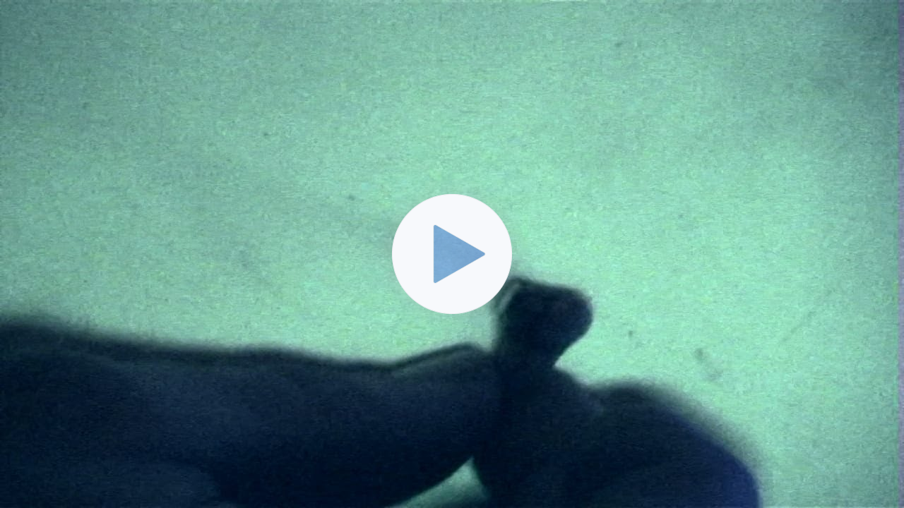 Smoking Teeth -- Toxic Dental Mercury Fillings also known as "silver amalgam fillings"