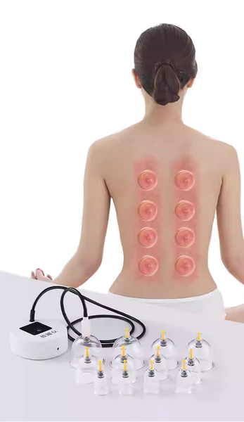 Terapia con ventosas al vacío