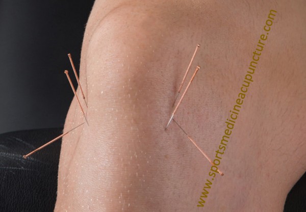 Acupuncture needles in a knee