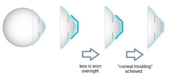 Ortho K lens 