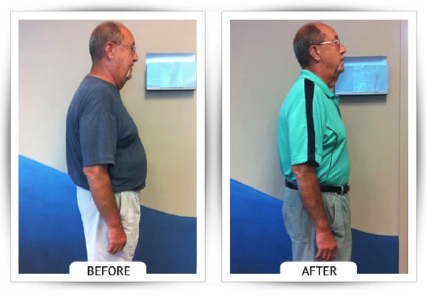 ChiroThin before and after weight loss transformation