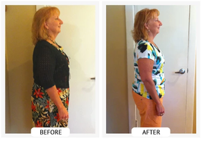 ChiroThin patient before and after weight-loss result