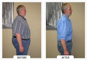 ChiroThin patient before and after weight-loss result