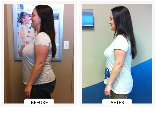 ChiroThin before and after weight loss transformation