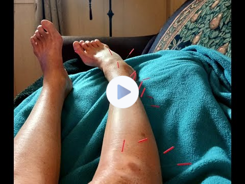 🏥👩‍⚕️Physician Heal Thyself!🪡Acupuncture ☯️ Laser on 🩼 Broken Bones🩼 Part One B4 video cut off!🫥