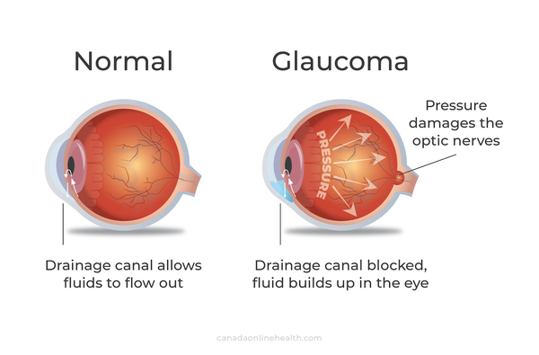 Glaucoma in eyes