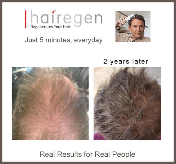 Best Hair Growth Treatment For Men Is DIY Hairegen Best Hair Growth Treatment For Men Is DIY Hairegen