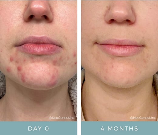 acne-clear skin trifecta