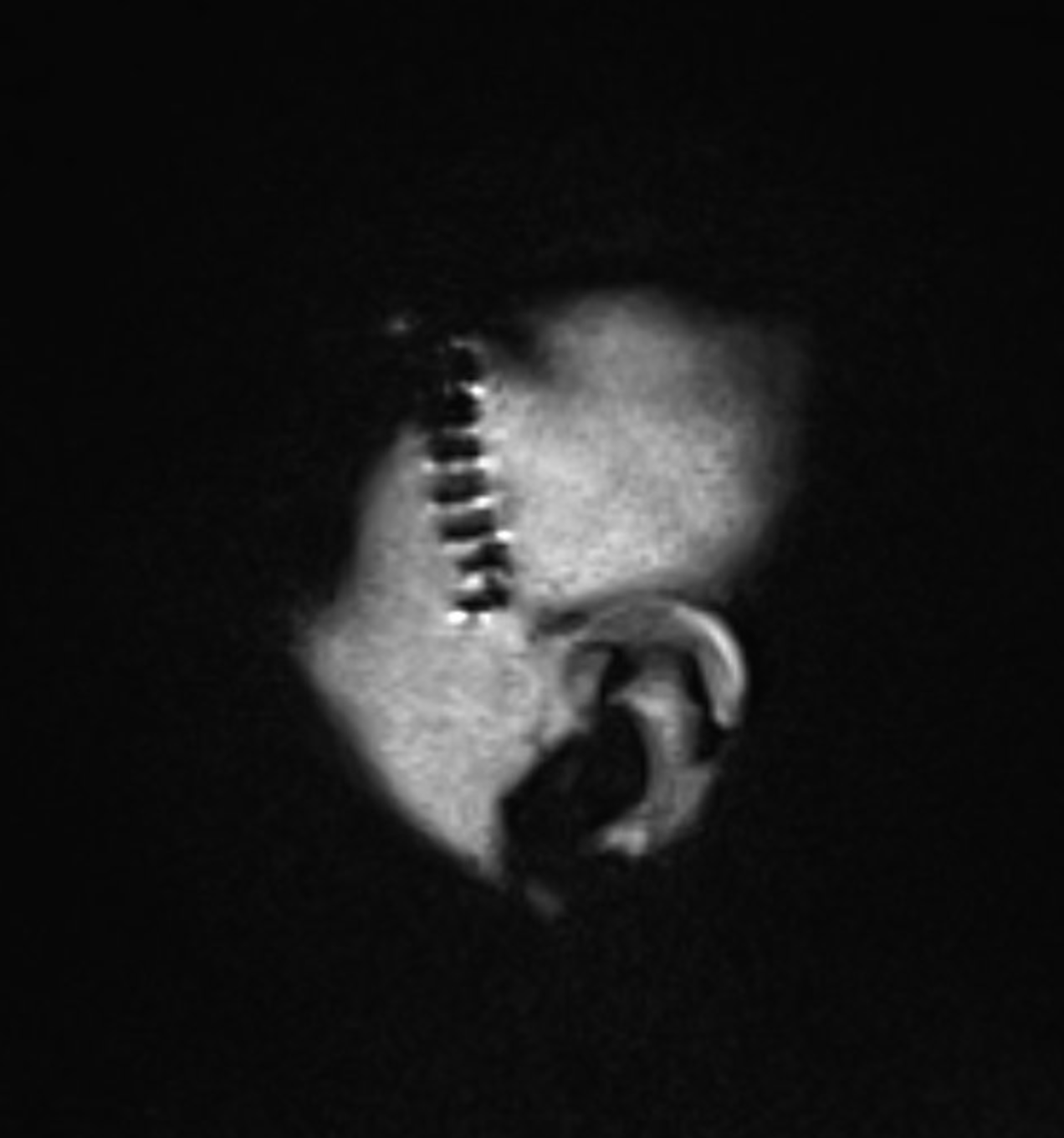 MRI / CT Scan showing staples from craniotomy in skull and ear