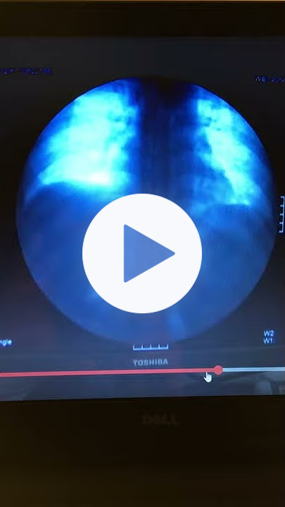 Diaphragm movement under fluoroscopy