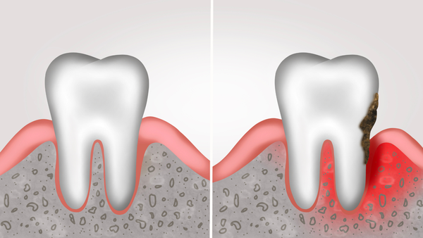 Periodontal Disease