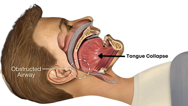 airway collapse
