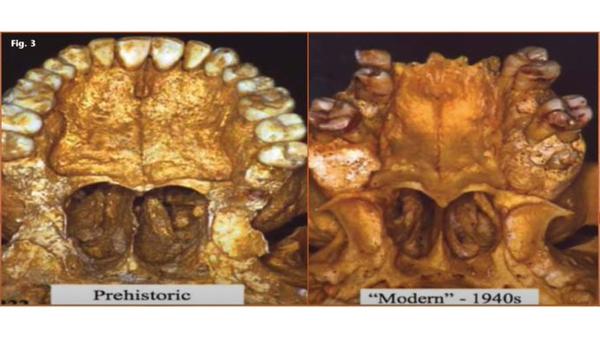 malocclusion