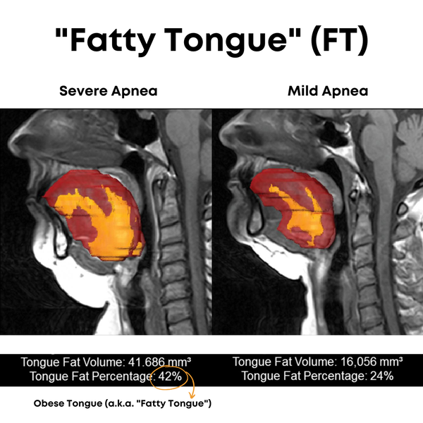 Fatty Tongue