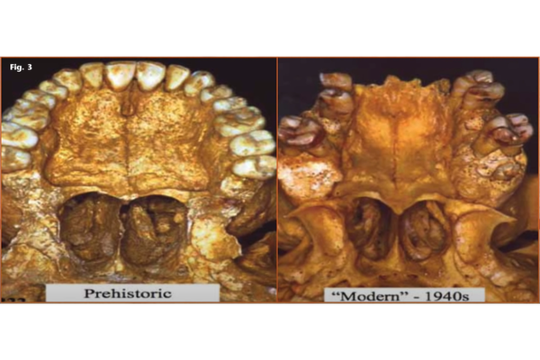 Palatal Width