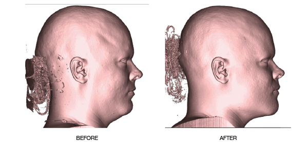 double jaw surgery