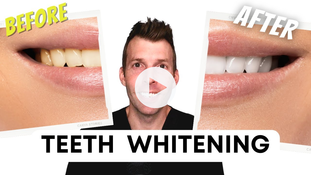 The best way to whiten teeth (what really works)
