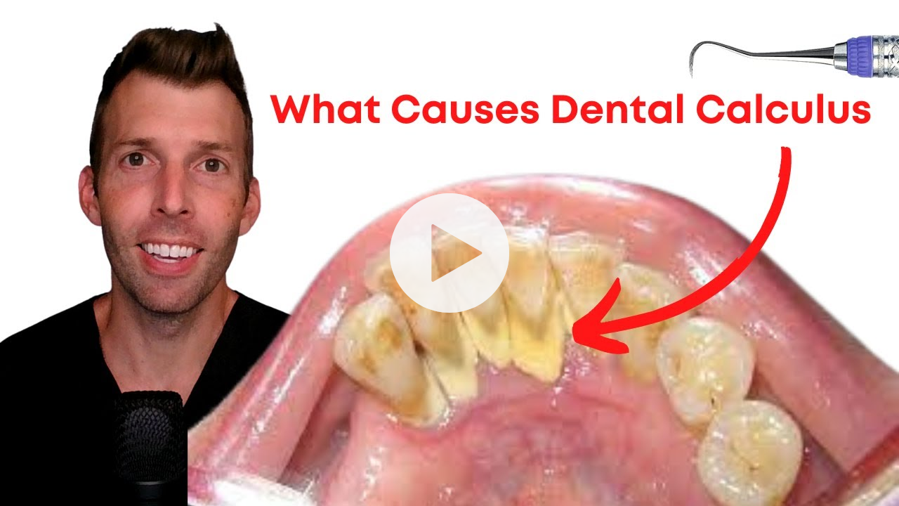 What DENTAL CALCULUS Really Means (on the Carnivore Diet)