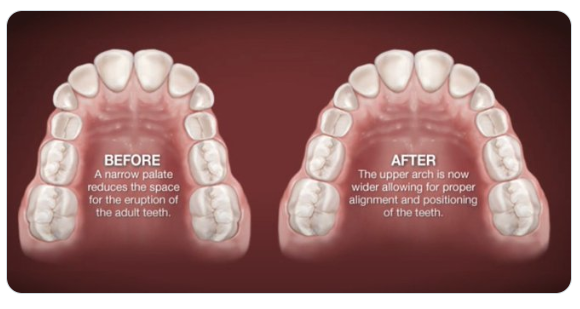 vaulted palate