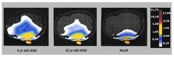Image courtesy of Dr. Om Gandhi, University of Utah, 1996, IEEE Publication