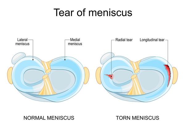 MeniscusTornMeniscus