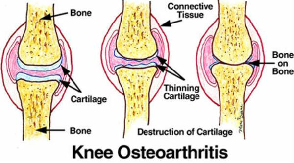 Knee OA