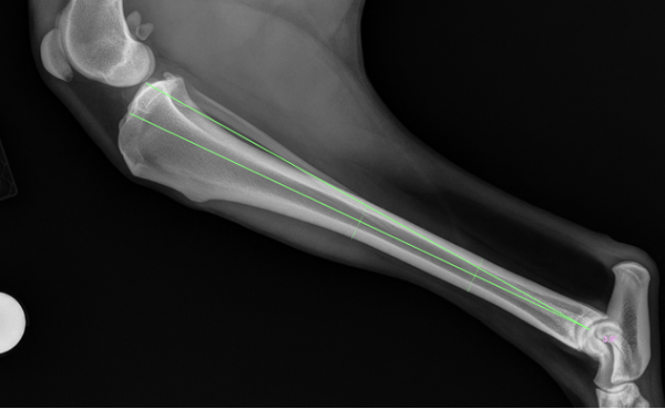 anatomical-mechanical axis angle