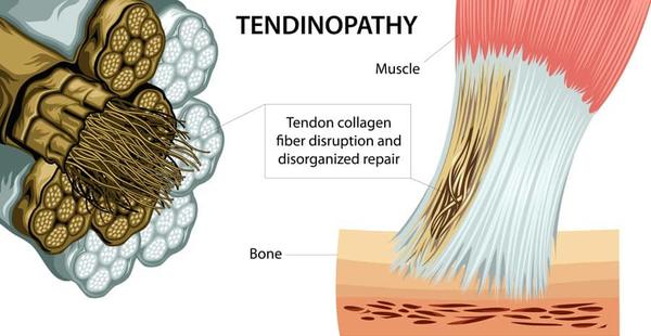 Tendinopathy