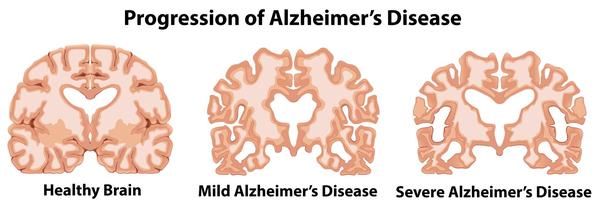 Alzheimer's Brain