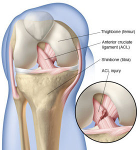 Cruciate Articles