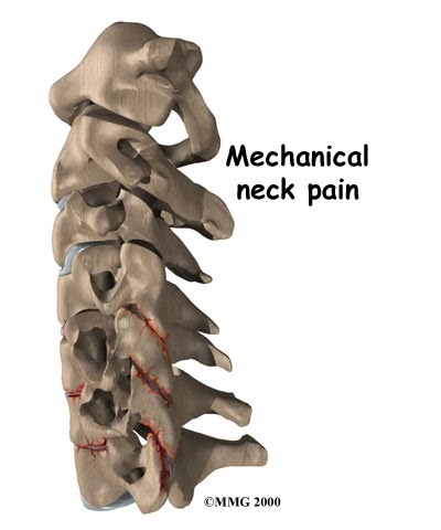 Mechanical Neck Pain