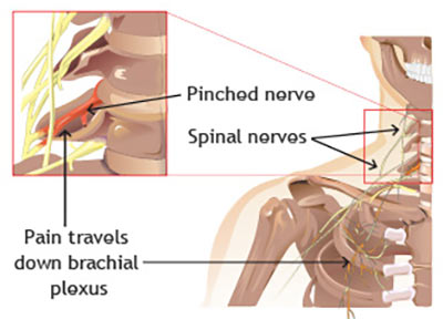 Pinched nerve