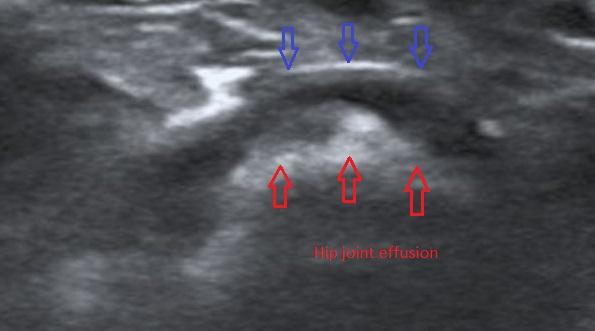 HIP Ultrasound image