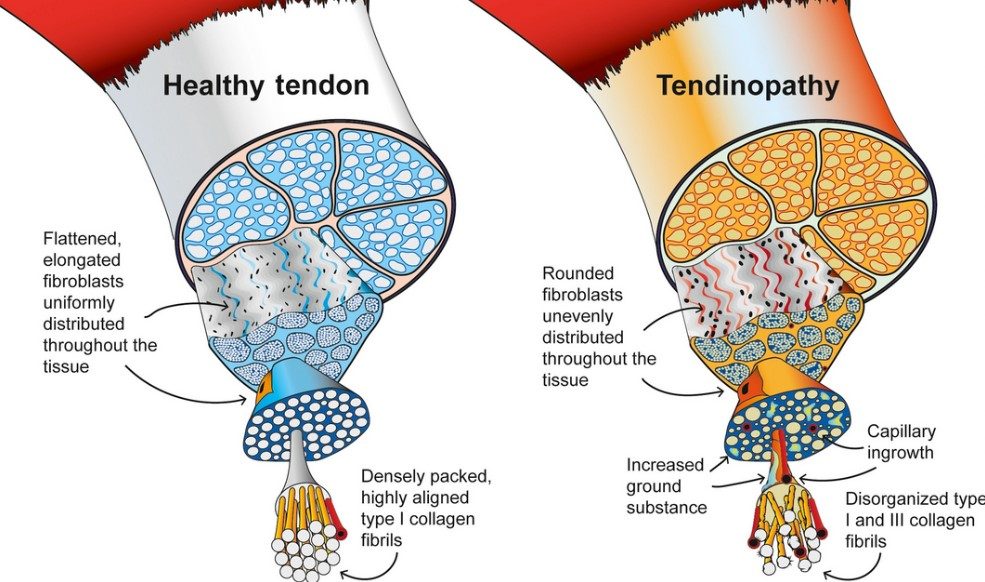 TENDINOPATHY2