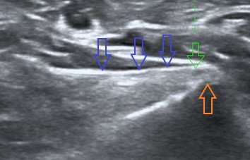 Iliopsoas Ultrasound image