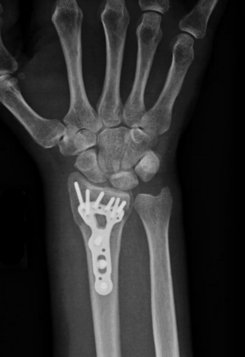 x-ray of radius repair (not Nathan)