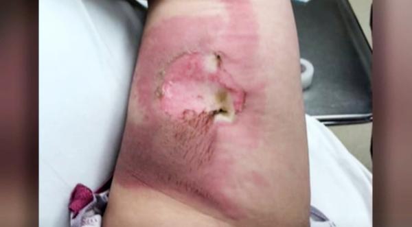 Woman Struck By Lightning While Holding Metal Cup