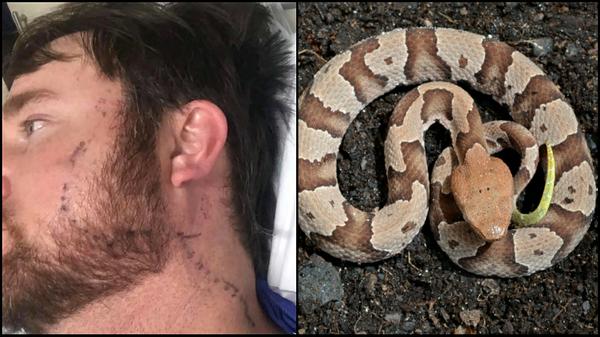 Hunter Bitten On Head By Venomous Snake Hiding In Tree