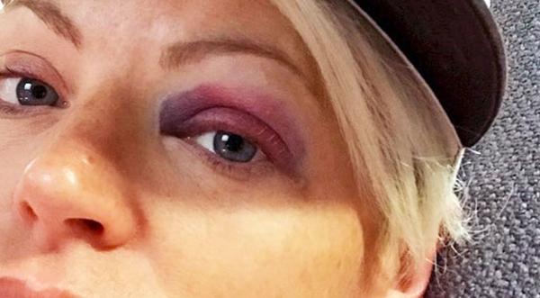 Dixie Chicks' Natalie Maines Shares Painful Photos Of Black Eye